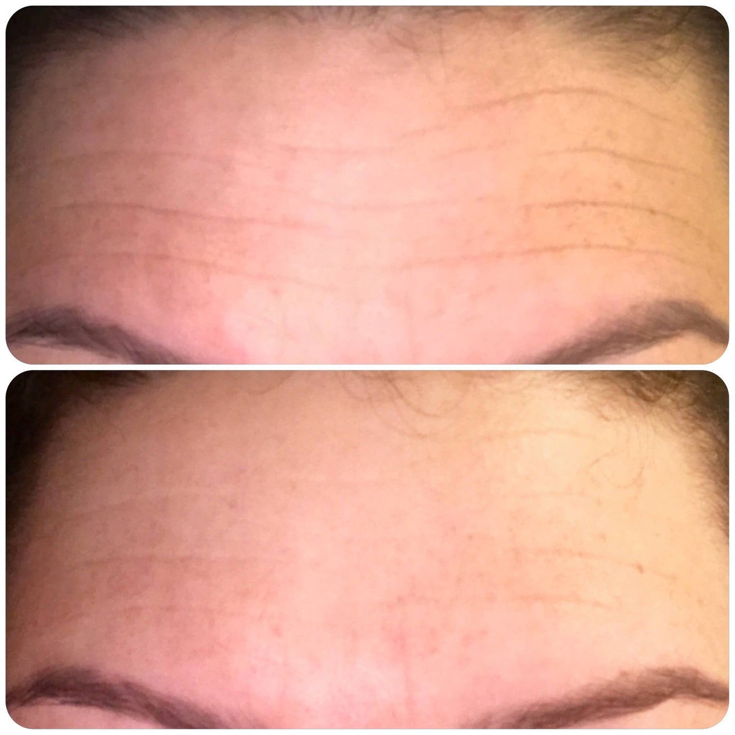 Kami Pure Anti Wrinkle Forehead Pad - Botox Alt 30 uses