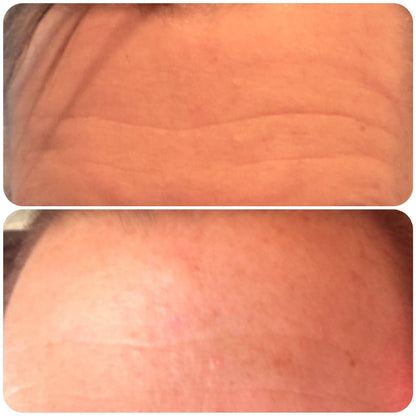 Kami Pure Anti Wrinkle Forehead Pad - Botox Alt 30 uses